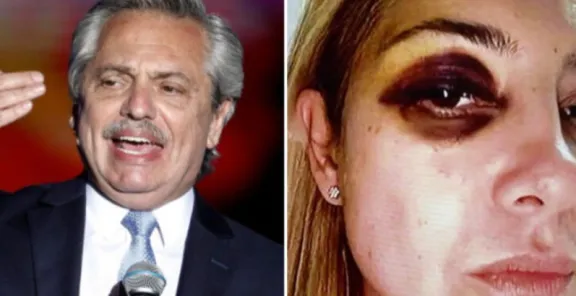Autodefensa: Alberto Fernández afirma que su expareja tenía un ojo morado por "un tratamiento" para las arrugas