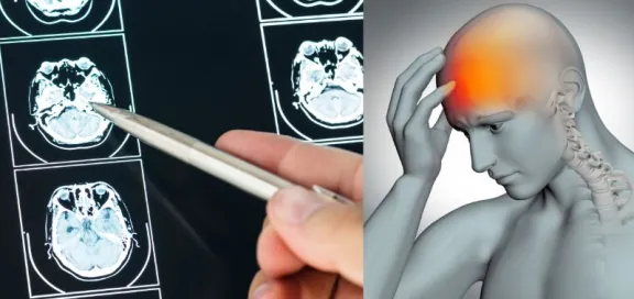 ¿Accidente cerebrovascular? Mira qué es y cuáles son sus señales de alerta