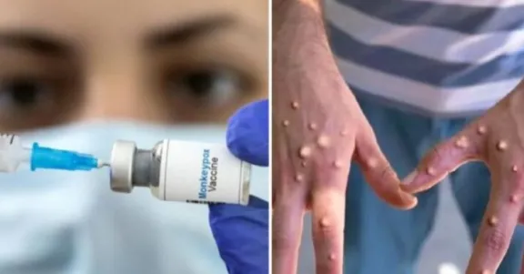 Mpox o Viruela del Mono: ¿Quiénes se deben vacunar contra la enfermedad en Chile?